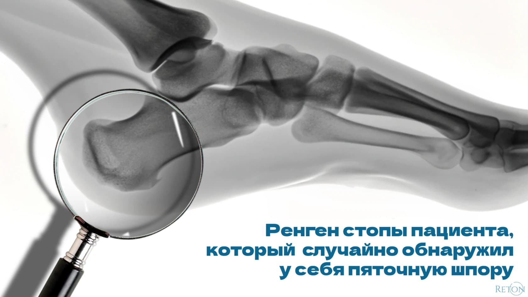 Симптомы пяточной шпоры