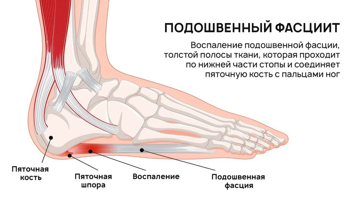 Пяточная шпора и боль в стопе