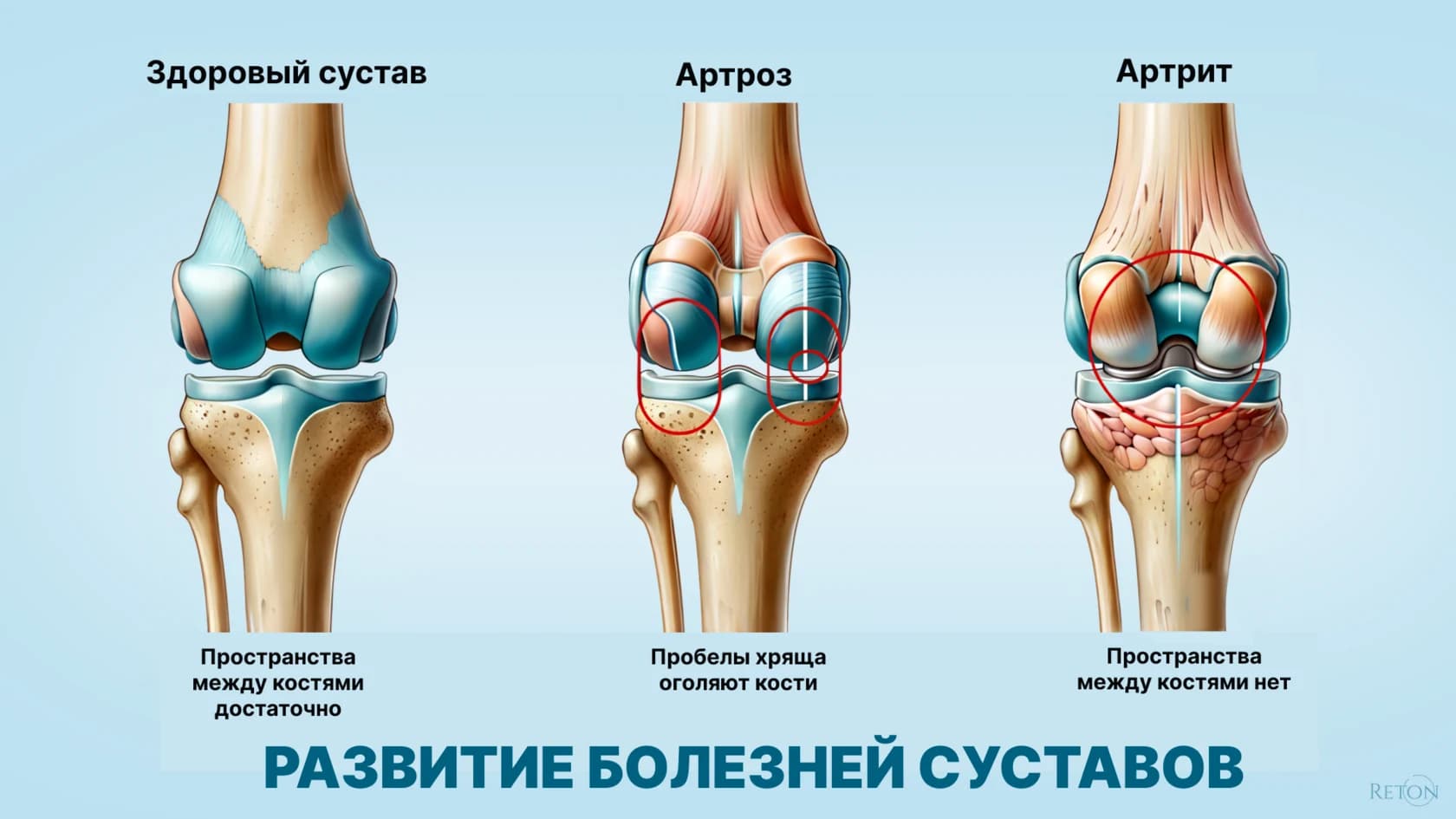 Боль и скованность суставов
